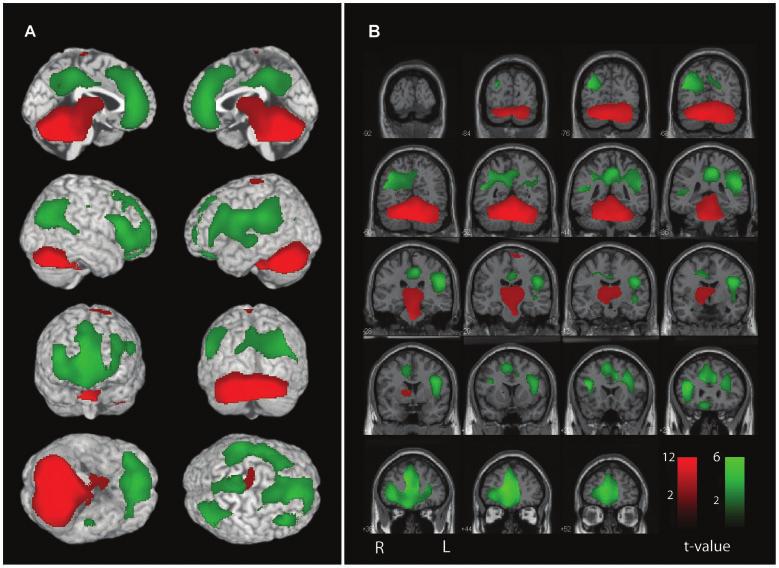 Generalized tonic clonic seizures networks Brain 2009: 132; 999 1012 1009 Figure 7 Network correlations between cerebellar CBF changes and other brain regions.