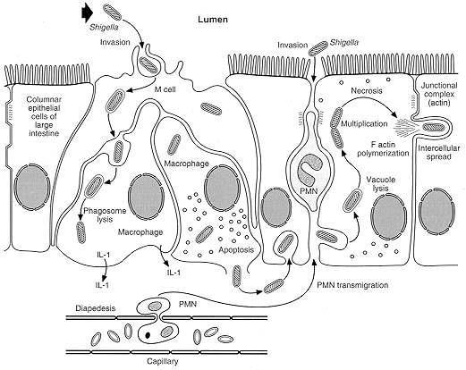 FIGURE 22-2 Gross pathology of shigellosis. However, virulent shigellae are not killed and digested in the macrophage phagolysome.