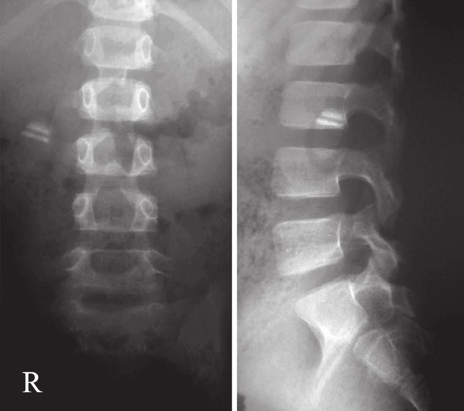 Asian Spine Journal Myxopapillary ependymoma in child 847 (MRI) scan of the lumbar spine showed a tumor in the cauda equina. He was referred to our hospital and was Fig. 1.