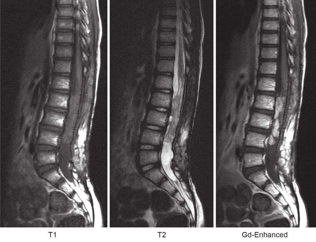 Asian Spine Journal Myxopapillary ependymoma in child 849 pain and motor neuron deficits were not observed. We performed subtotal resection with laminectomy from L1 to L4 (Fig. 5).