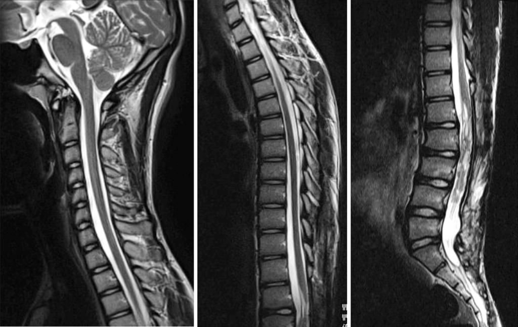 850 Masashi Uehara et al. Asian Spine J 2014;8(6):846-851 Fig. 6. Magnetic resonance imaging of the entire spine nine years after the second surgery showed no evidence of residual tumor regrowth. Fig. 7.