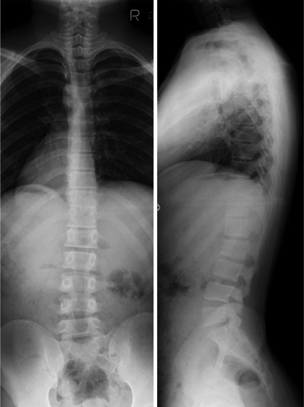 The 5-year-old boy in the current report was the youngest of patients in the earlier reports. Complete resection of myxopapillary ependymomas is associated with excellent long-term prognosis.