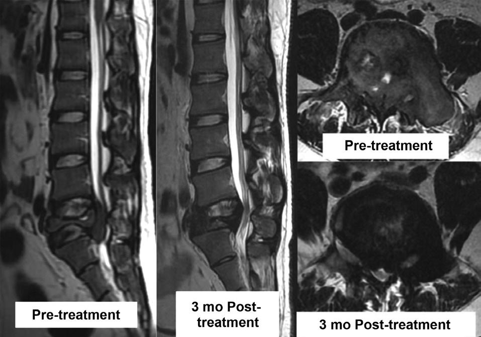 946 Simret Singh Randhawa et al. Asian Spine J 2016;10(5):945-949 tensor hallucis longus (L5) was grade 2 and ankle plantar flexion (S1) was grade 4. Anal tone was lax with absent perianal sensation.