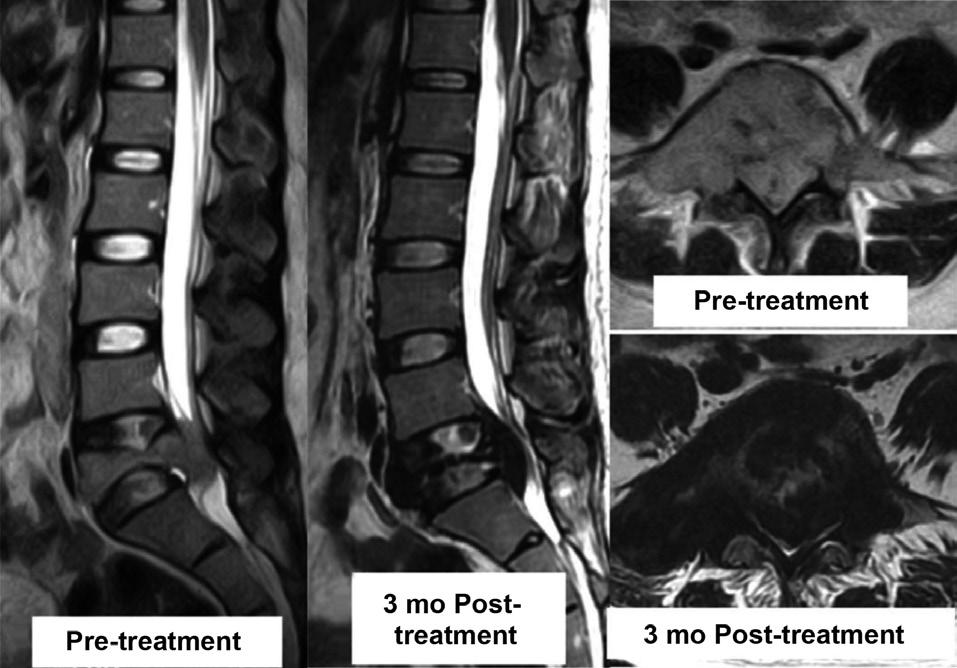 Computed tomography (CT) and magnetic resonance (MR) scans showed a large extradural mass located dorsal and extending to the left pedicle of the L5 vertebra with destruction of L5 vertebral body and