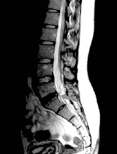 Discogenic Low Back Pain Pearls More likely with younger patients Physical Examination Patients may stand during office visit Pain reproduced with axial loading, lumbar flexion Neuro WNL Testing