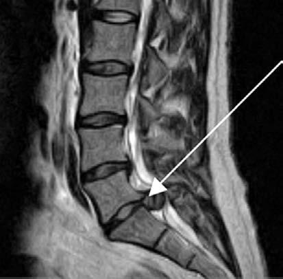 Cauda Equina Syndrome Pearls May report saddle distribution numbness, loss of control of bowel/bladder function Physical Examination Neuro: perineal sensory deficit, loss of anal sphincter tone, may