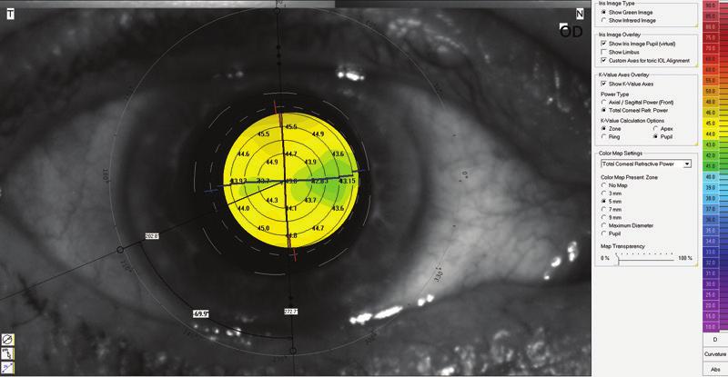 A B Figure 3. The Pentacam AXL can perform densitometric evaluation with its Corneal Optical Densitometry and Pentacam Nucleus Staging software. Figure 2.