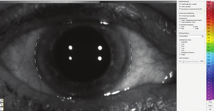 corneal refractive power in toric IOL calculations.