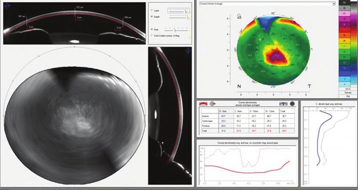 to be an excellent way to calculate the total corneal astigmatism. We believe that optimization of our A-constants will further improve our results.