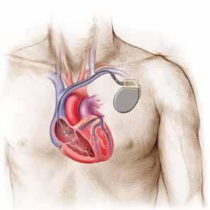 Cardioversion External cardioversion Your doctor may recommend external cardioversion to restore a normal heart rhythm.