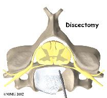 Discectomy In a discectomy, the surgeon removes the disc where it is pressing against a nerve. Surgeons usually perform this surgery from the front (anterior) of the neck.