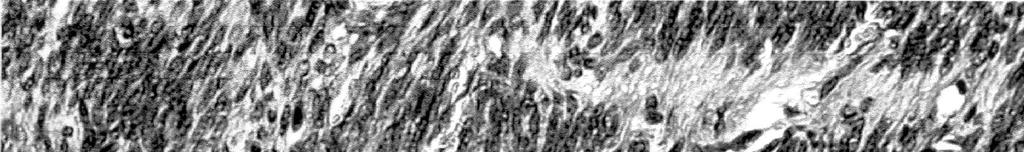 186 P. Ramasamy et al. Fig. 2. Higher magni cation of the cellular schwannoma composed of elongated spindle cells that form a striking palisading pattern.