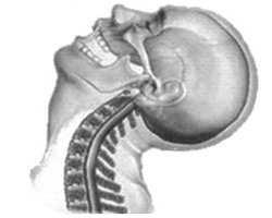 Hyperextension of cervical vertebrae Can cause a fracture to spinous process, ruptured