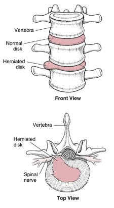 HERNIATED DISK Annulus ring weakens causing the nucleus pulposus to
