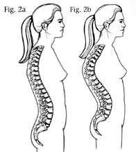 LORDOSIS Exaggeration of lumbar curve swayback Due