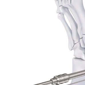 4.0 mm Cannulated Screw Technique for Medial Malleolus Fracture 5 Insert screw Instruments 03.119.027 Cannulated 2.