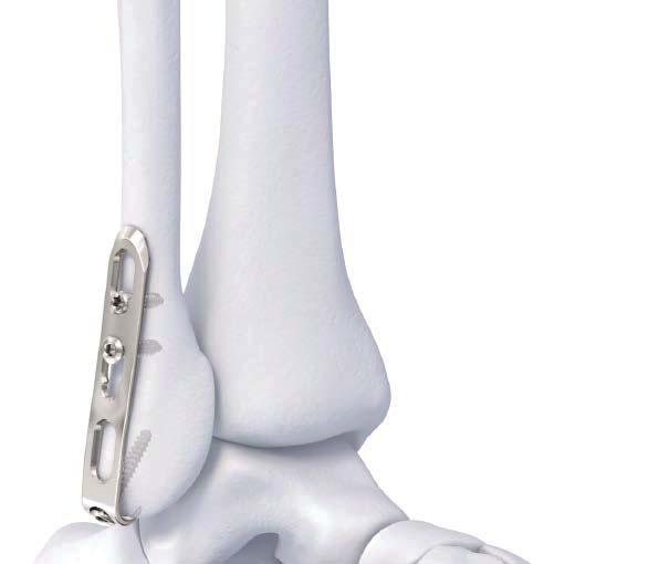 Compact Ankle Fracture System Implants 3.