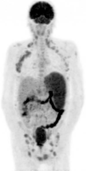 Mantle Cell Lymphoma 59-year-old man Fatigue, weight loss Clinical exam: splenomegaly, adenopathies Inguinal node biopsy
