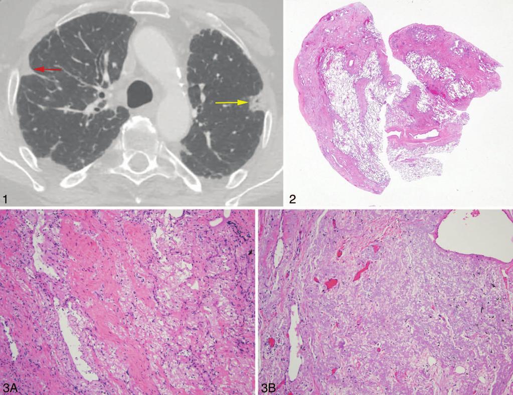 Figure 1. Chest computed tomography findings interpreted as worrisome for adenocarcinoma in situ of the left upper lobe, which was resected and showed pulmonary apical cap.