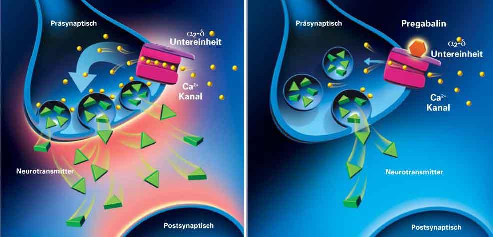 Mechanism of action of Pregabalin Excessive neurotransmitter release in