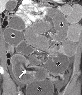 Hryhorczuk et al. Fig. 1 Obstructing Meckel diverticulum (surgically confirmed) in 8-year-old girl who presented with acute onset of abdominal pain.