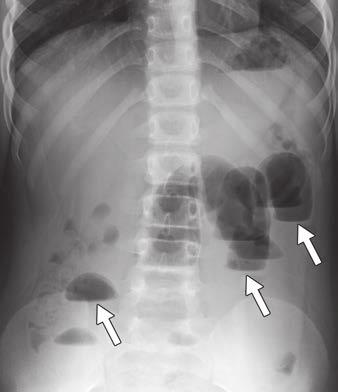 Given patient s age and appearance of intussusception on CT, there was high suspicion for pathologic lead point, and patient was taken for surgery, where he underwent
