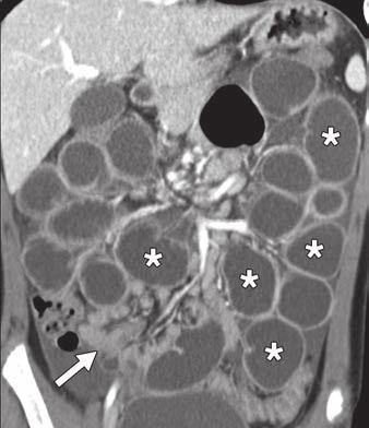 Surgery confirmed presence of malrotation and midgut volvulus. Patient subsequently underwent Ladd procedure.
