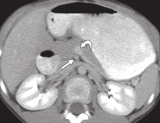 owel Obstructions in Older Children C Fig. 4 Malrotation in 8-year-old boy who presented with vomiting and abdominal pain.