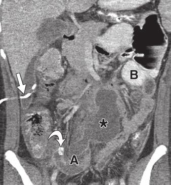 5 Incarcerated inguinal hernia in 2-year-old boy who presented with vomiting. Patient underwent surgical reduction of incarcerated inguinal hernia without complication.