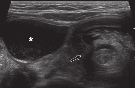 owel Obstructions in Older Children Fig. 7 Ileocolic intussusception in 3-month-old girl who presented with vomiting. Radiographs (not shown) revealed dilated loops of bowel.