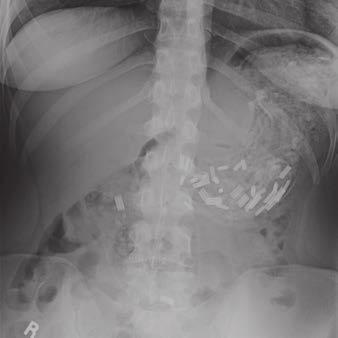, Sagittal CT image shows diaphragmatic hernia with bowel () and omental fat (F) extending through defect in diaphragm (arrows). Fig.
