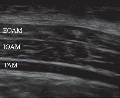 Ultrasound guided transversus abdominal plane (TAP) block versus caudal block for postoperative analgesia in children undergoing unilateral open inguinal herniotomy: a comparative study Dr. Ashraf A.