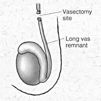 Does the way my vasectomy was performed affect my chances for a successful reversal? The site of the vasectomy is a factor in the outcome of reversal surgery.
