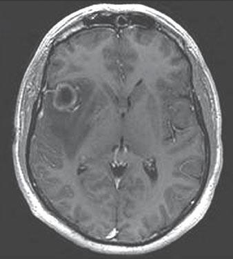 MRI to Diagnose Glioblastoma Multiforme TABLE 1: Patient Age and Sex, Mean Minimum Apparent Diffusion Coefficient (ADC) Values, and Mean ADC Ratios for Glioblastomas and Metastases Patient