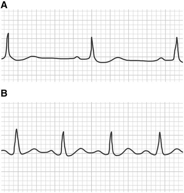 They result from premature depolarization that produces a normal QRS because atrioventricular node conduction is normal. FIGURE 1. Electrocardiogram waveforms of single heart beat in sinus rhythm.