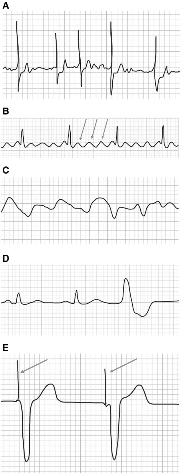 FIGURE 3. (A) Rhythm strip demonstrating first-degree atrioventricular block with PR interval of.200 ms.