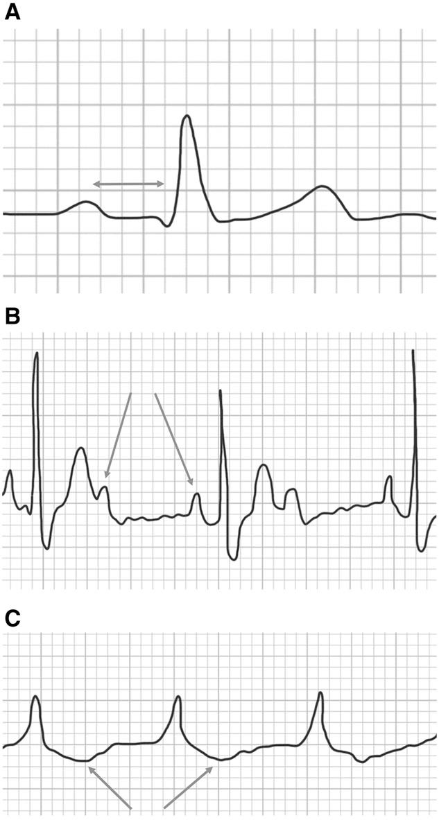 (C) Rhythm strip demonstrating third-degree atrioventricular block. Atrioventricular dissociation results in no QRS but prominent P wave.