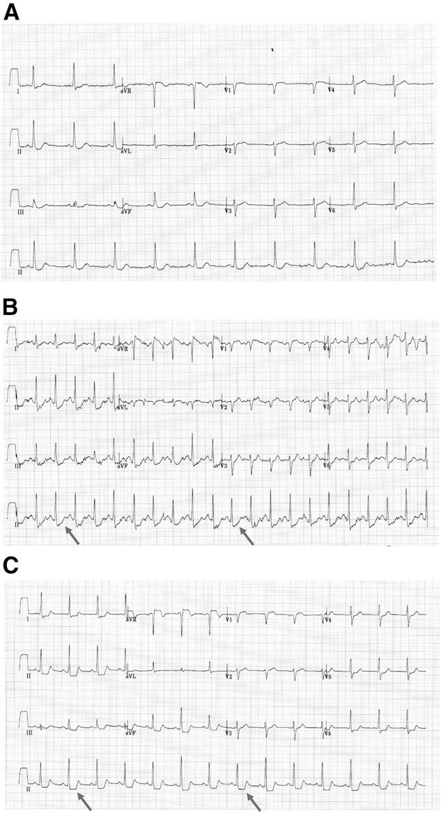 rhythm is sinus, the relationship between the P wave and the QRS should be checked. Atrioventricular block is present if the P wave is not entirely conducted.
