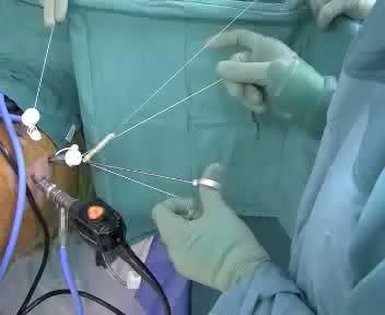7 1) Pass anchor suture through each end of graft using free needle.