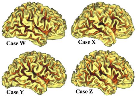 Variability and heritability of cortical
