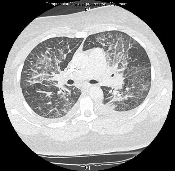 ENASIDENIB DIFFERENTIATION SYNDROME Differentiation Syndrome occurs in 14% associated with: Respiratory symptoms such as supplemental oxygen requirement (76%) Renal dysfunction (70%) Fever (36%)