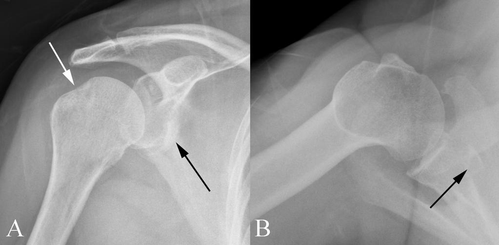 Acute post-traumatic shoulder pain: CT
