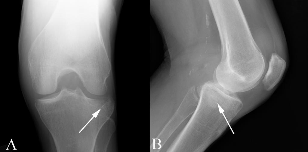 Acute post-traumatic knee pain: