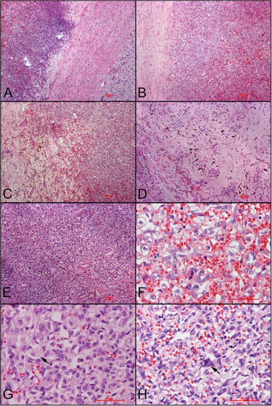 Liu et al. Diagnostic Pathology 2012, 7:49 Gross features The left kidney was normal in size (12.0 5.0 4.0 cm). A 1.2 cm well-encapsulated mass was found in the upper pole of left kidney.