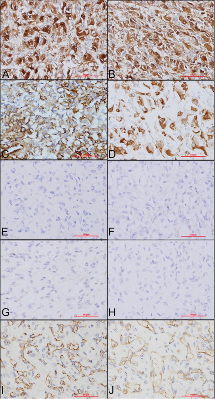 Liu et al. Diagnostic Pathology 2012, 7:49 Page 3 of 5 Figure 2 Immunohistochemical staining. A: Positive staining for NSE. B: Positive staining for S100 protein. C: Positive staining for vimentin.