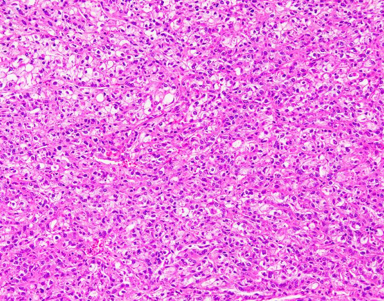 ASPL-TFE3-associated neoplasm; (B) the tumor is composed of compactly arranged, lightly eosinophilic cells with less abundant cytoplasm and prominent nucleoli, typical of a PRCC-TFE3- associated