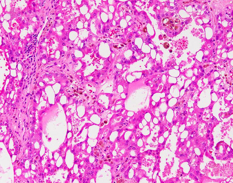 eosinophilic cytoplasm are frequently seen in ACD-RCC; (C) prominent intratumoral oxalate crystals were observed under polarized light. RCC, renal cell carcinoma.