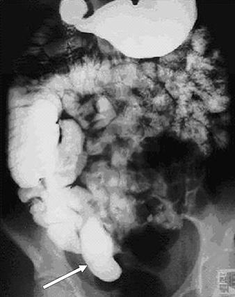 Imaging of Meckel s Diverticulum event. Perforation is usually secondary to inflammatory diverticulitis, gangrene, and peptic ulceration [20 22].