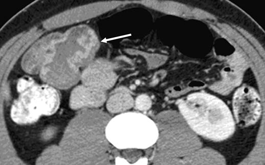 Imaging of Meckel s Diverticulum Fig. 6 26-year-old woman.