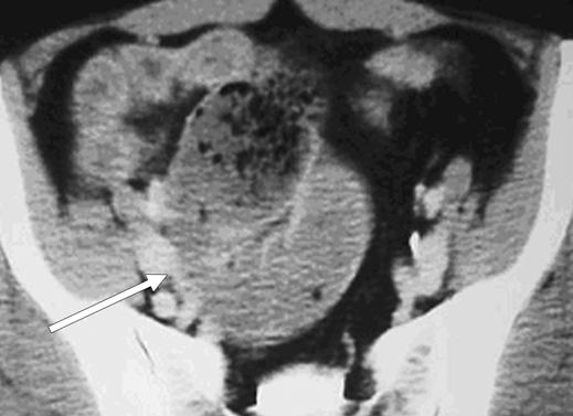 structure (arrow, ) resulting in small-bowel obstruction.